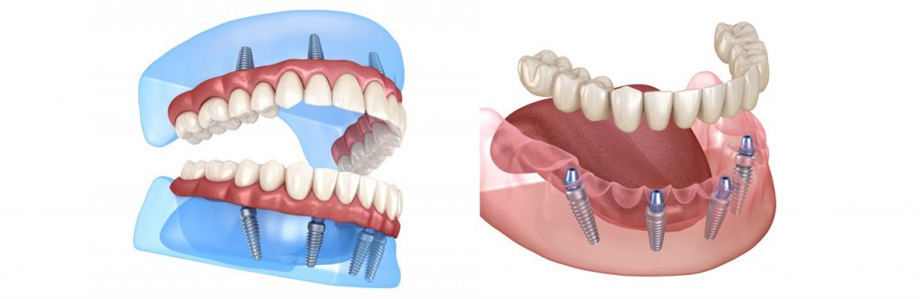 All new teeth in a single procedure